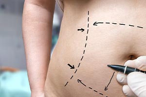 Tummy tuck procedure