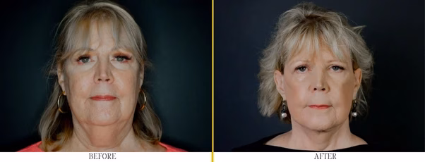 Regency Before After 602 x 230 px 2.webp